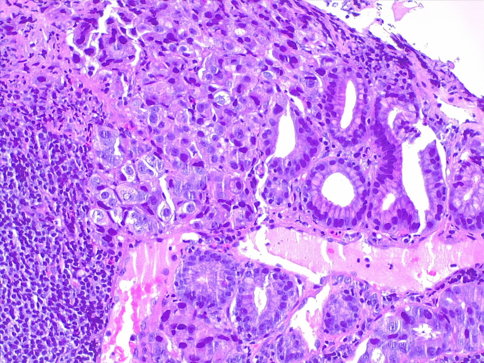 <p>Gastric Carcinoma. 10&times; H/E histologic specimen of gastric cancer.</p>