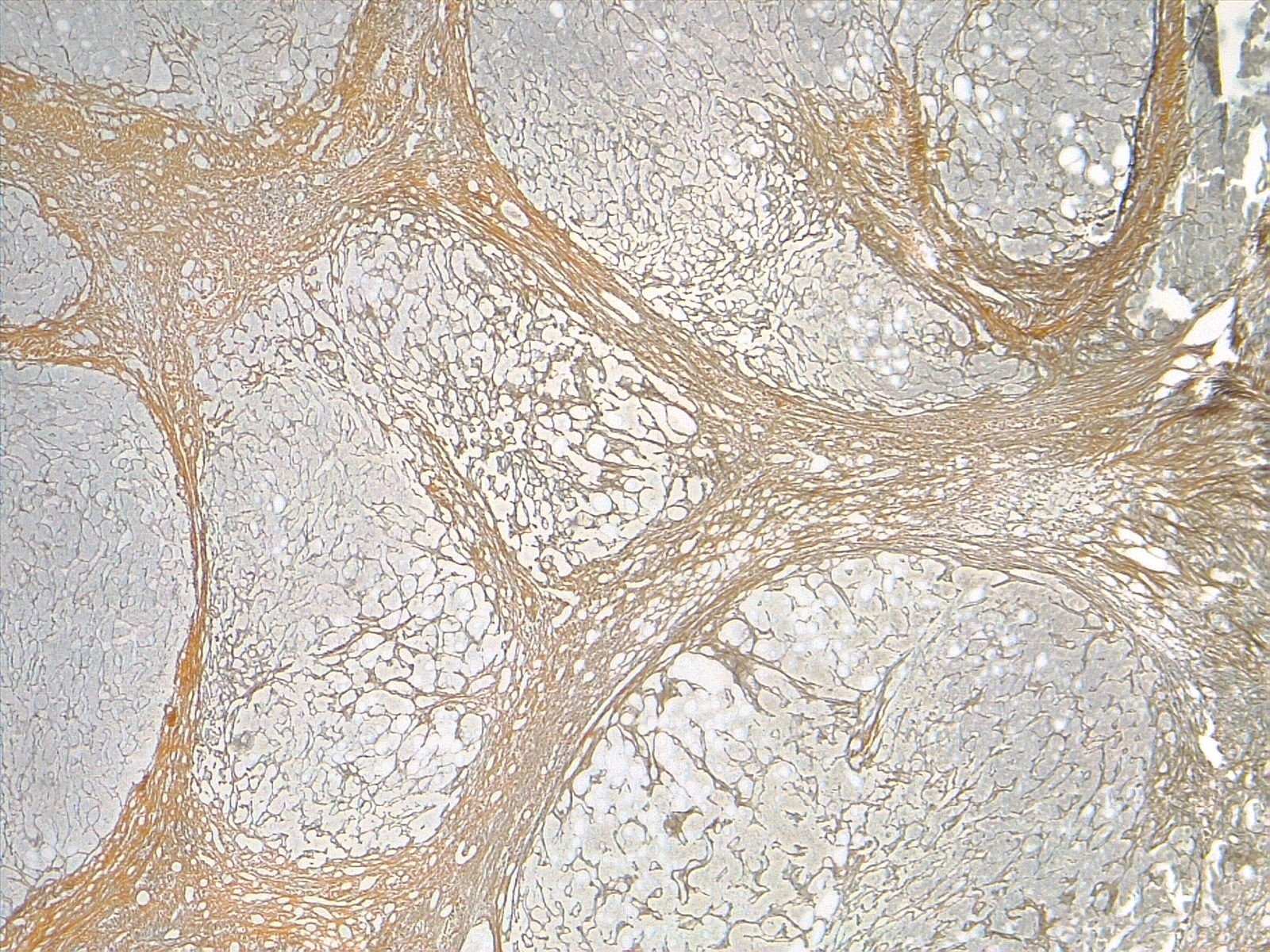 <p>Cirrhosis, Liver. Reticulin stain enhances the fibrous septa dividing the hepatic nodules, &times;4 magnification.</p>