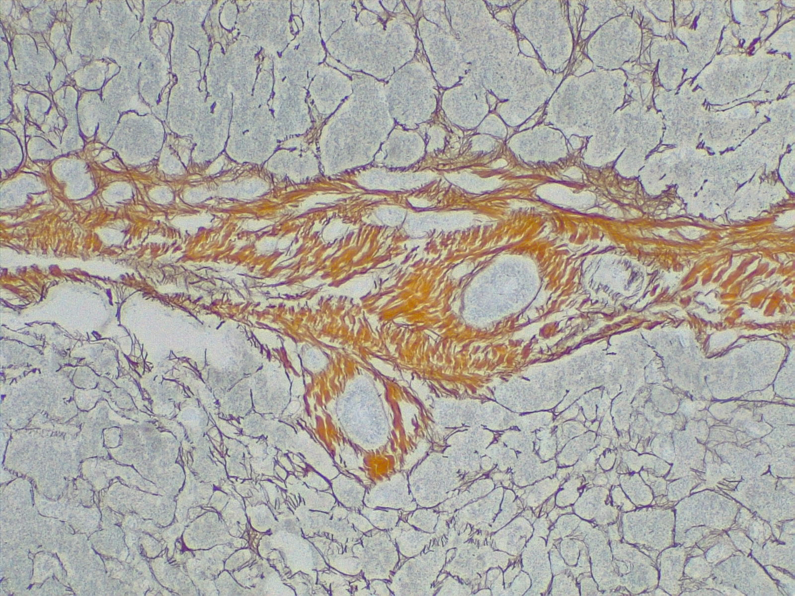 <p>Cirrhosis, Portal Space in Fibrous Septa. Reticulin stain 4&times;.</p>