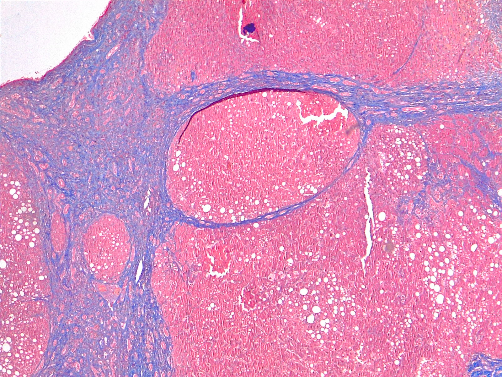 <p>Liver Cirrhosis,&nbsp;Trichrome Stain, 4&times;</p>