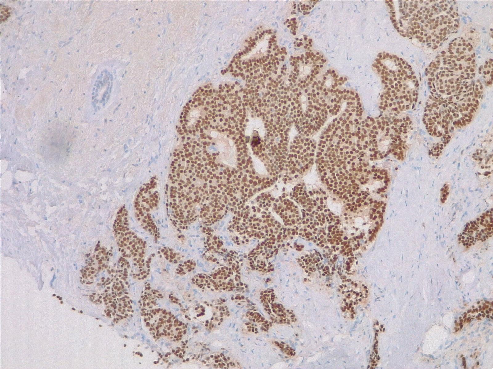 Estrogen receptor expression in breast carcinoma, ER stain 4x