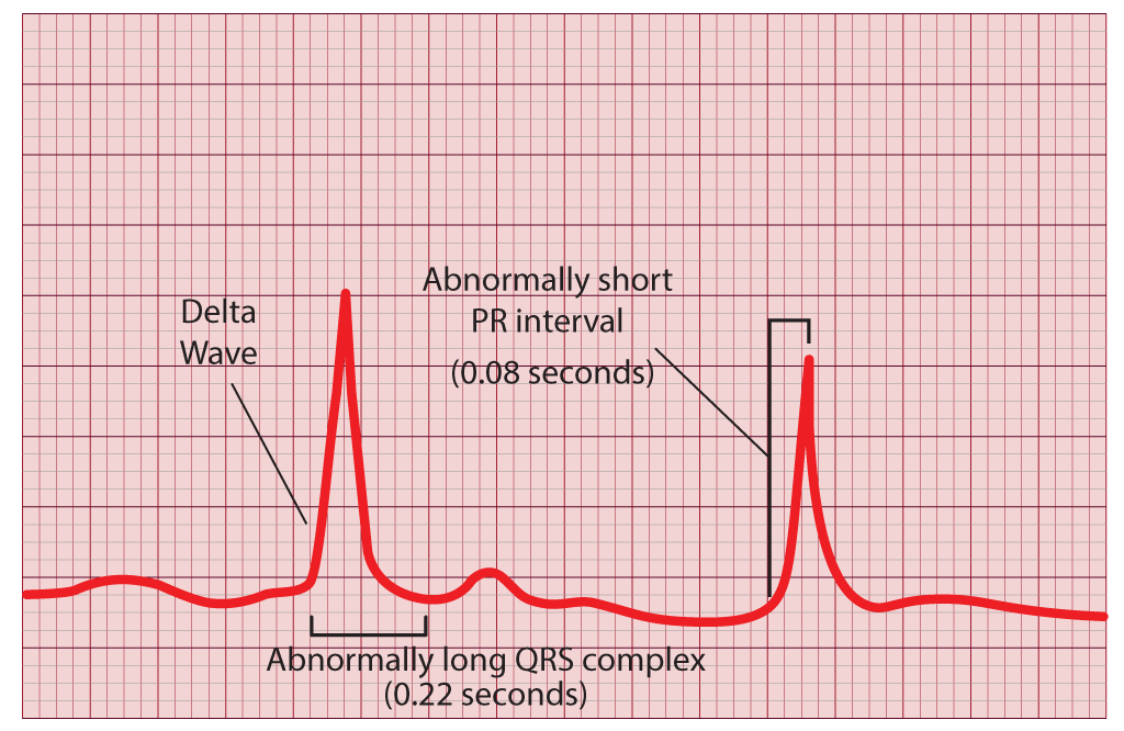 <p>Wolff-Parkinson-White Syndrome