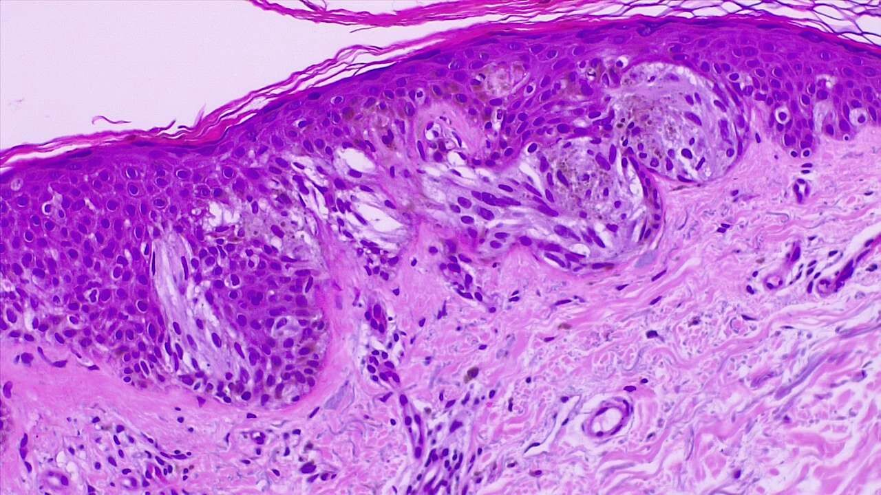 Malignant melanoma of the skin. Epidermal invasion by atypical melanocytes, fused nests. H/E 4x