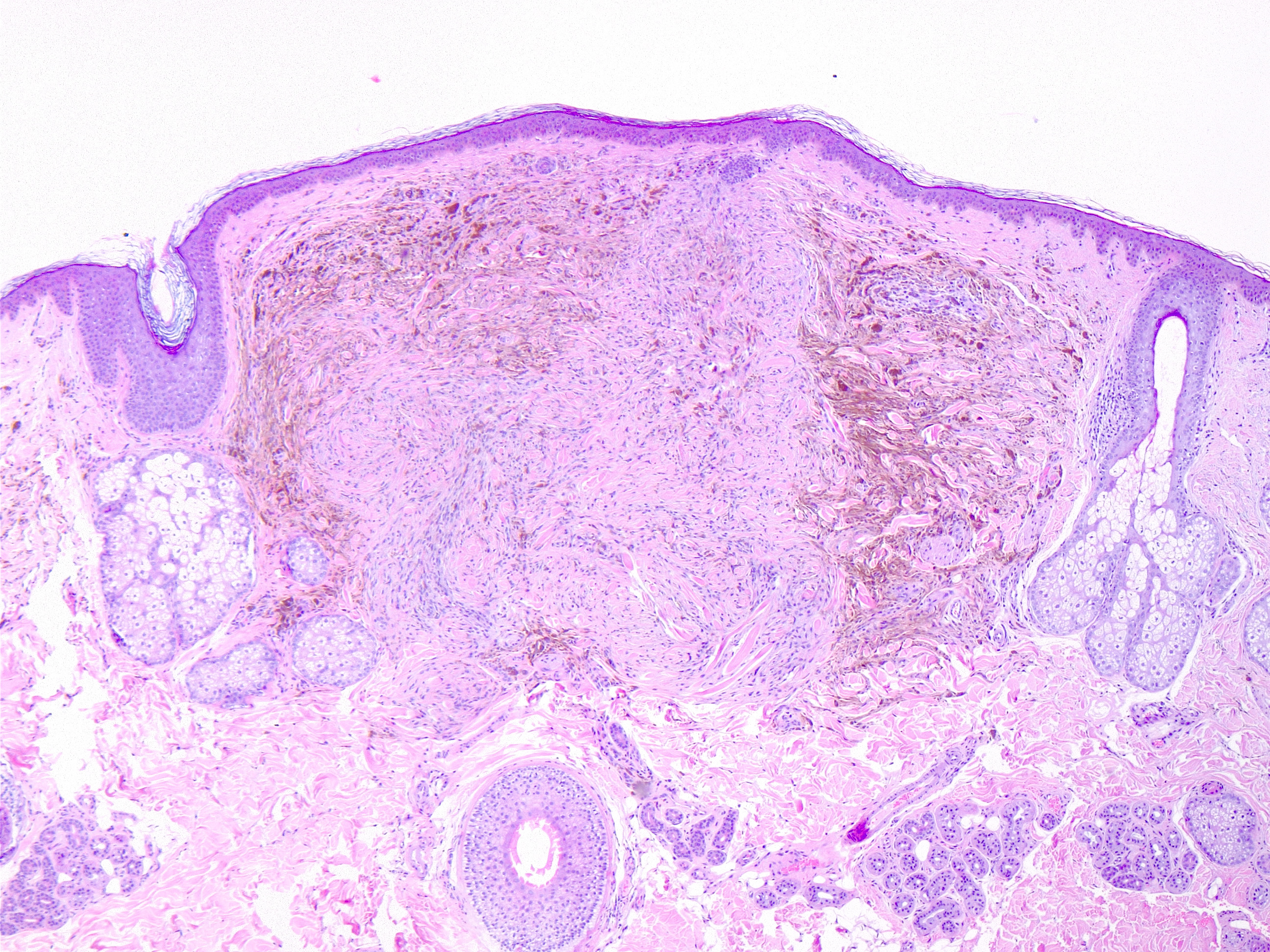 <p>Blue Nevus, H/E 4x