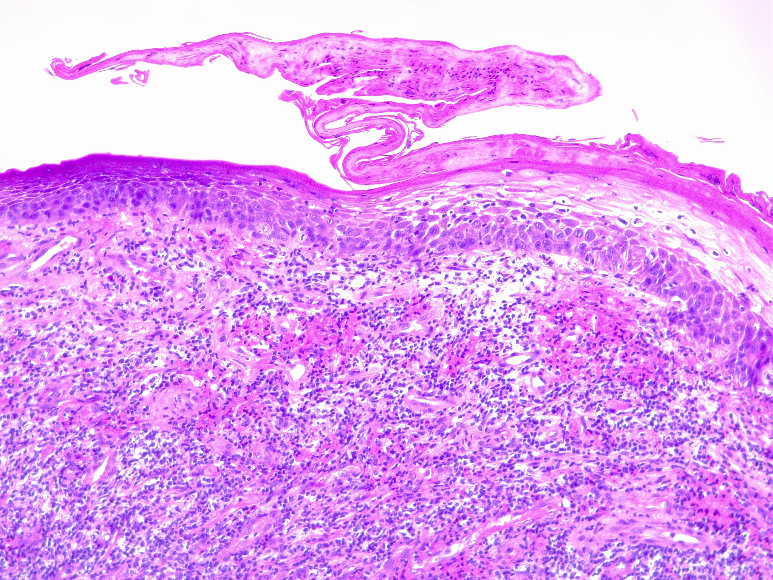 <p>Pyogenic Granuloma H/E 10&times;