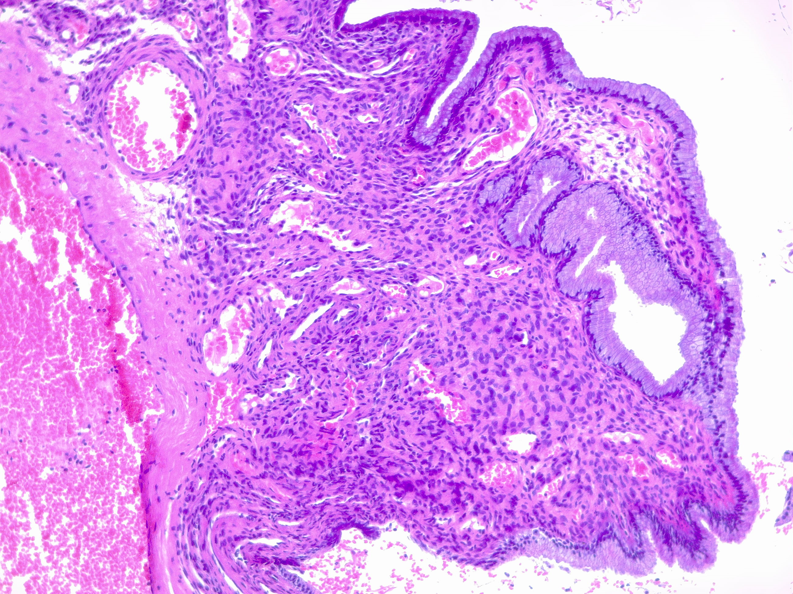 Endocervical polyp