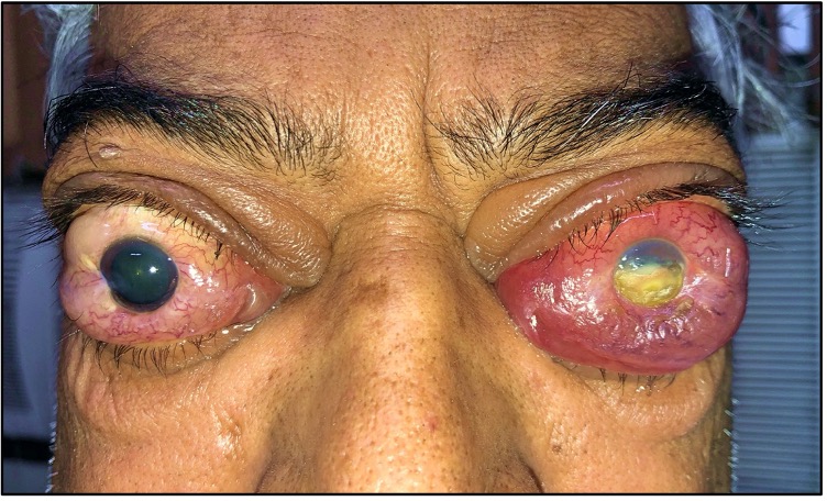 <p>Left Corneal Exposure Keratopathy With Bilateral Optic Nerve Involvement