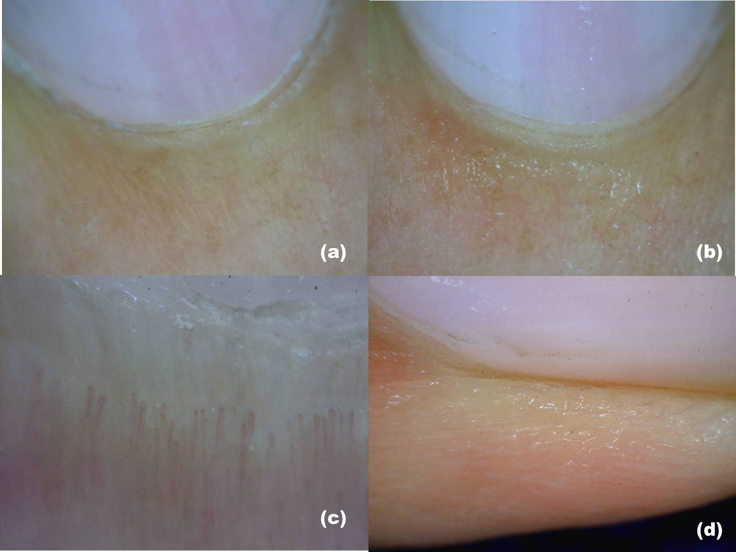 <p>Onychoscopy, Dermatologic Diagnosis