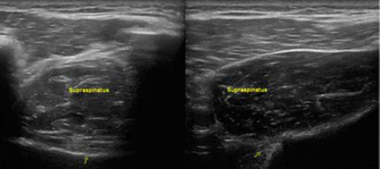 <p>Supraspinatus Muscle Atrophy, Ultrasound