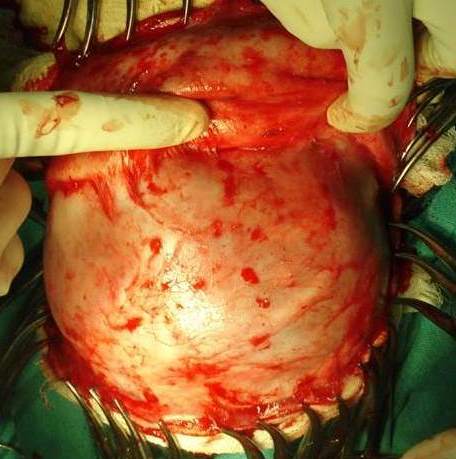 Peroperative picture after elevation of flap, showing flat frontal bone, elevated supraorbital margin, and fused coronal suture on right side