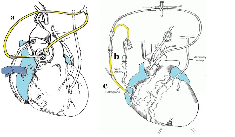 <p>Direct Coronary Perfusion Techniques