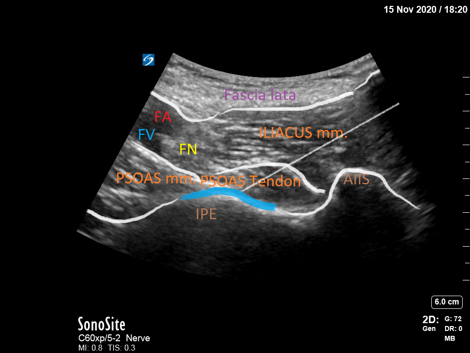 <p>Relevant Sonoanatomy of the PENG Block