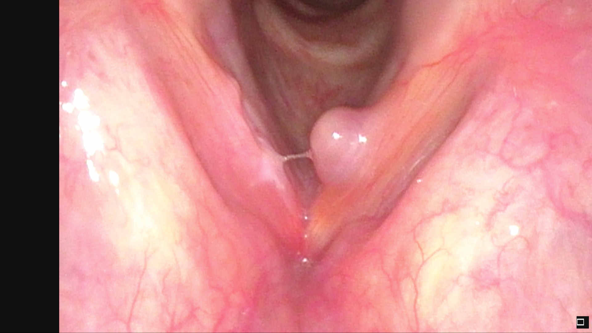 Vocal Fold Polyp