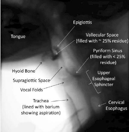 <p>Videofluoroscopic Swallowing Study