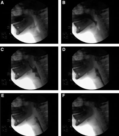 <p>Stages of the Swallowing Process