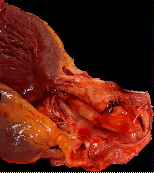 The ascending aorta presents a dissection a few centimeters above the aortic valve. Type A aortic dissection (Stanford system). 