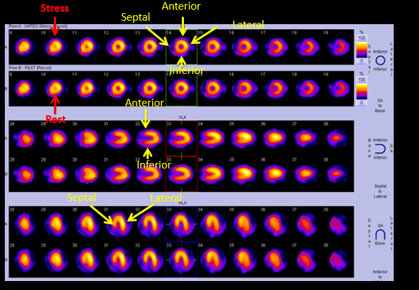 <p>Normal Myocardial Perfusion Scan Showing Location of Segments</p>