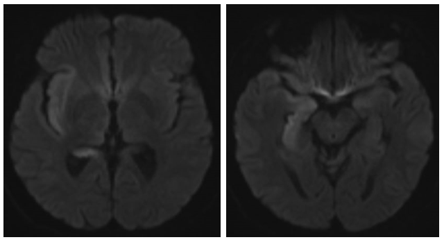 MRI brain showing diffusion restriction in right temporal and insular cortex.