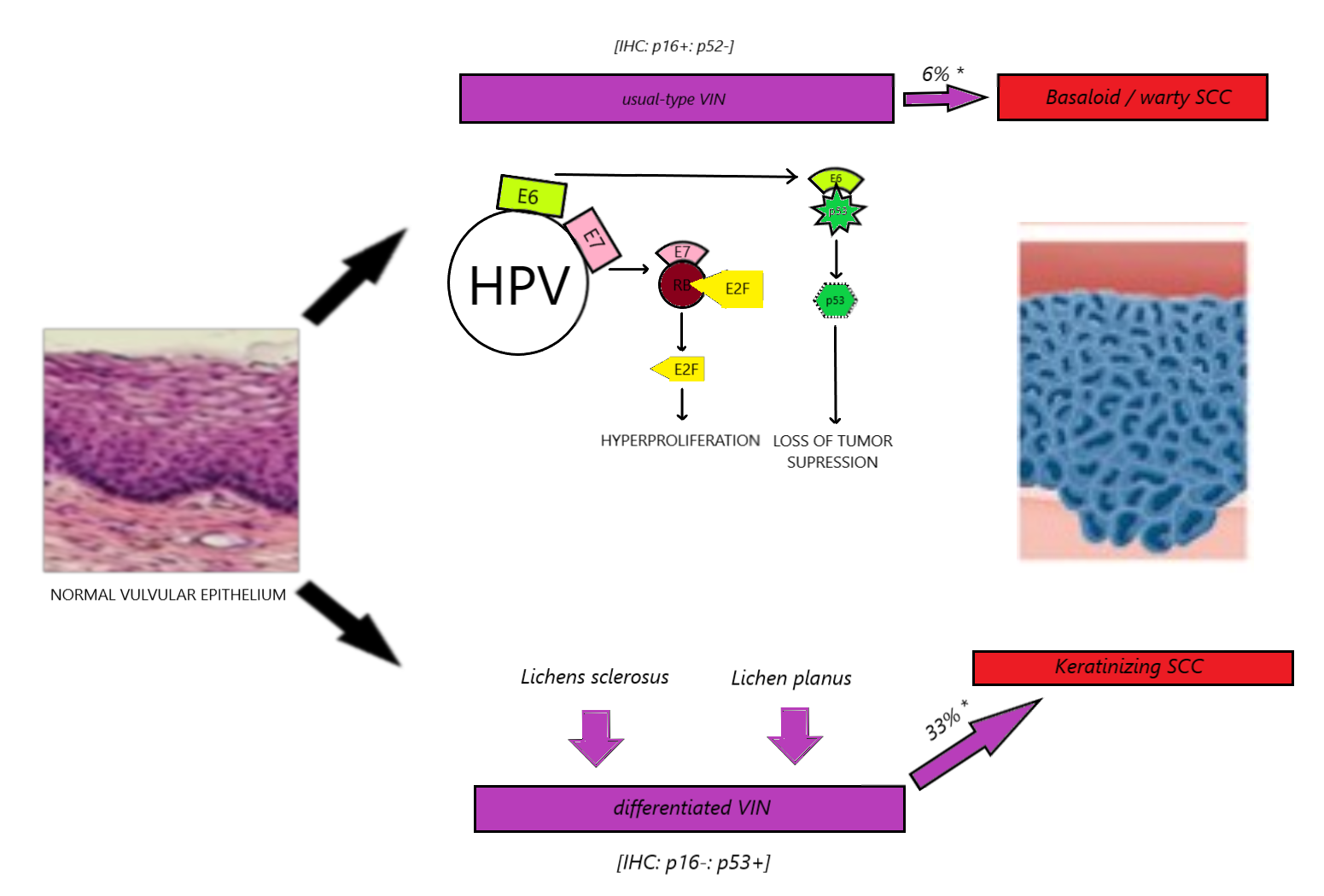 <p>Vulvar Cancer Development</p>