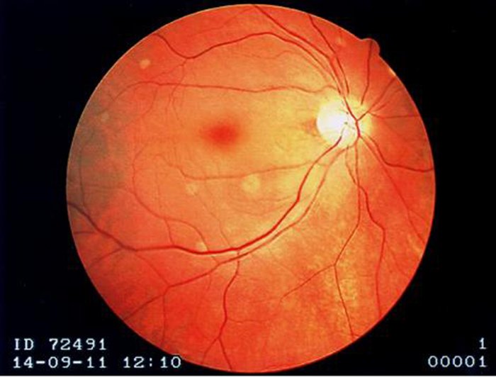 Fundoscopic exam findings in Central Retinal Artery Occlusions which includes a cherry red fovea, optic disk pallor, and boxcar segmentation of the retinal veins
