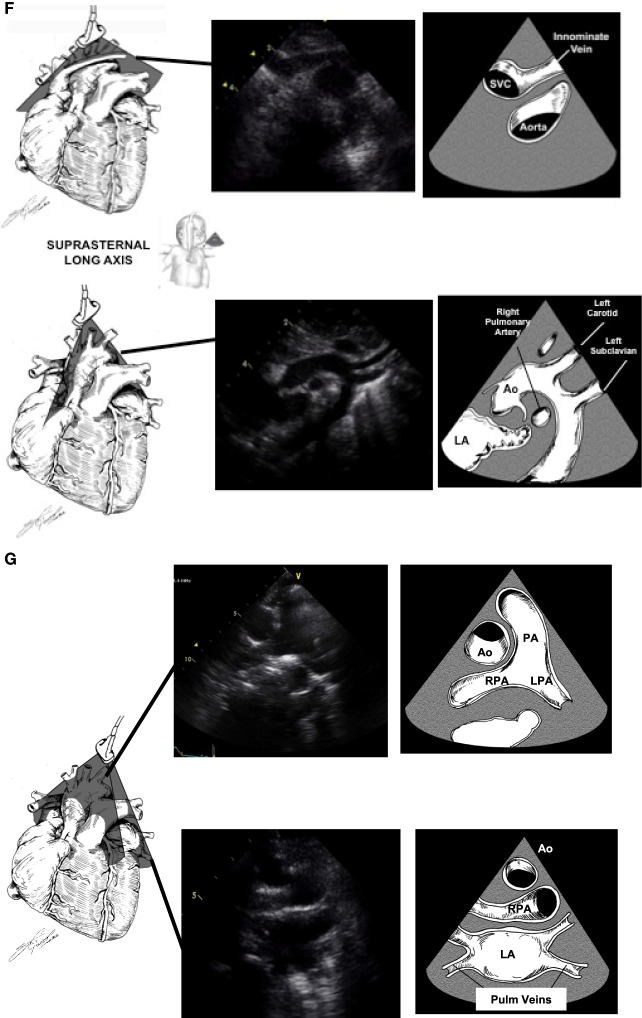 Pediatric TTE Suprasternal Window.