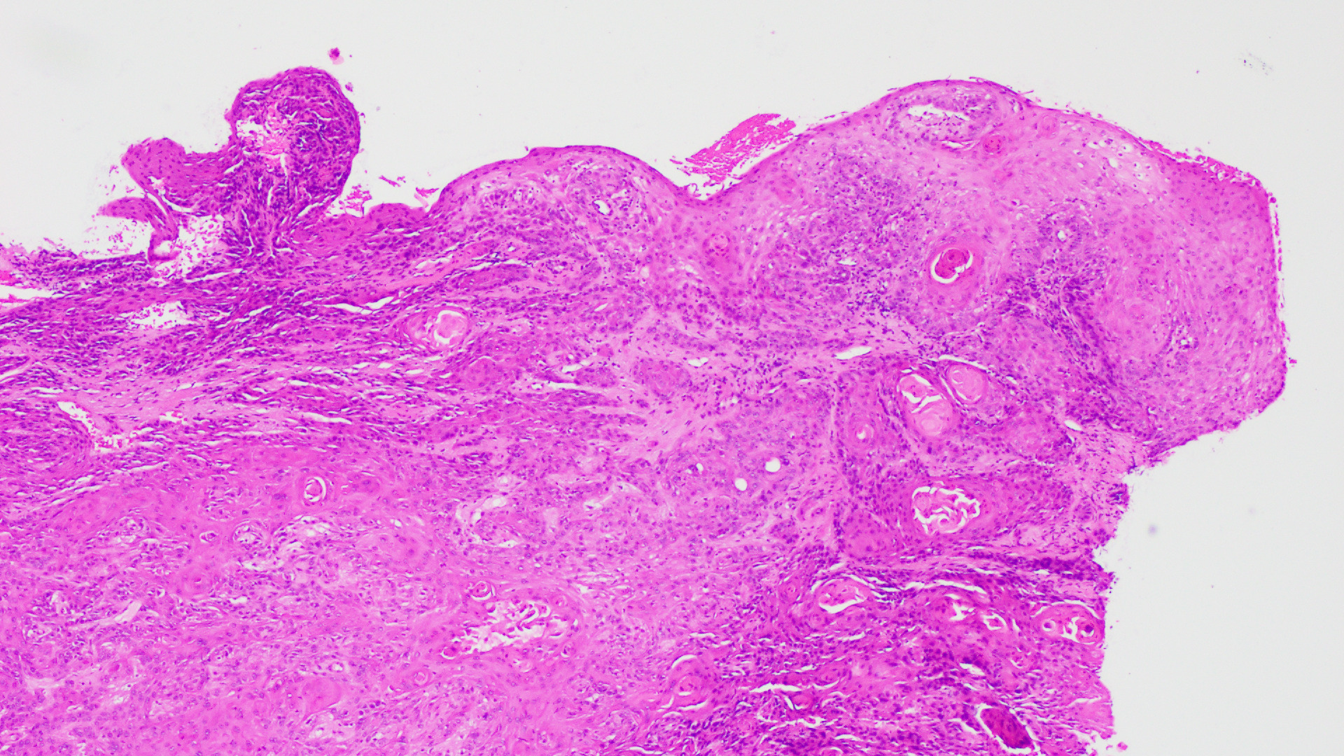 <p>Vulvar Squamous Cell Carcinoma, Histopathology