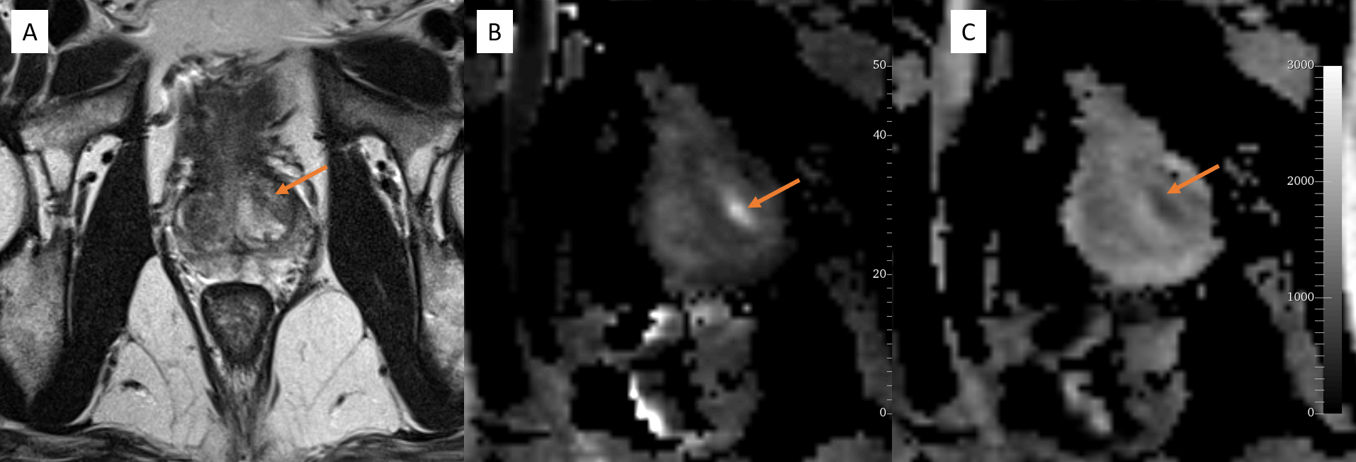 <p>MRI Prostate, PIRADS-3