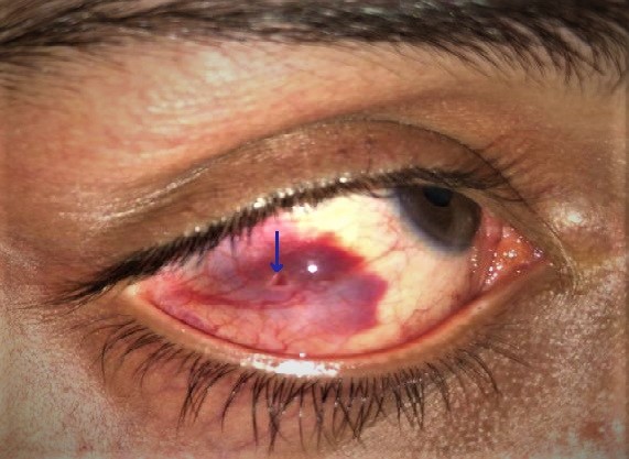 <p>Subconjunctival Hemorrhage