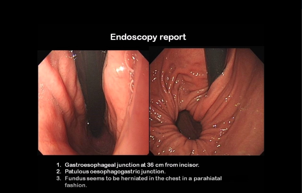 <p>Endoscopic View of a Parahiatal Hernia