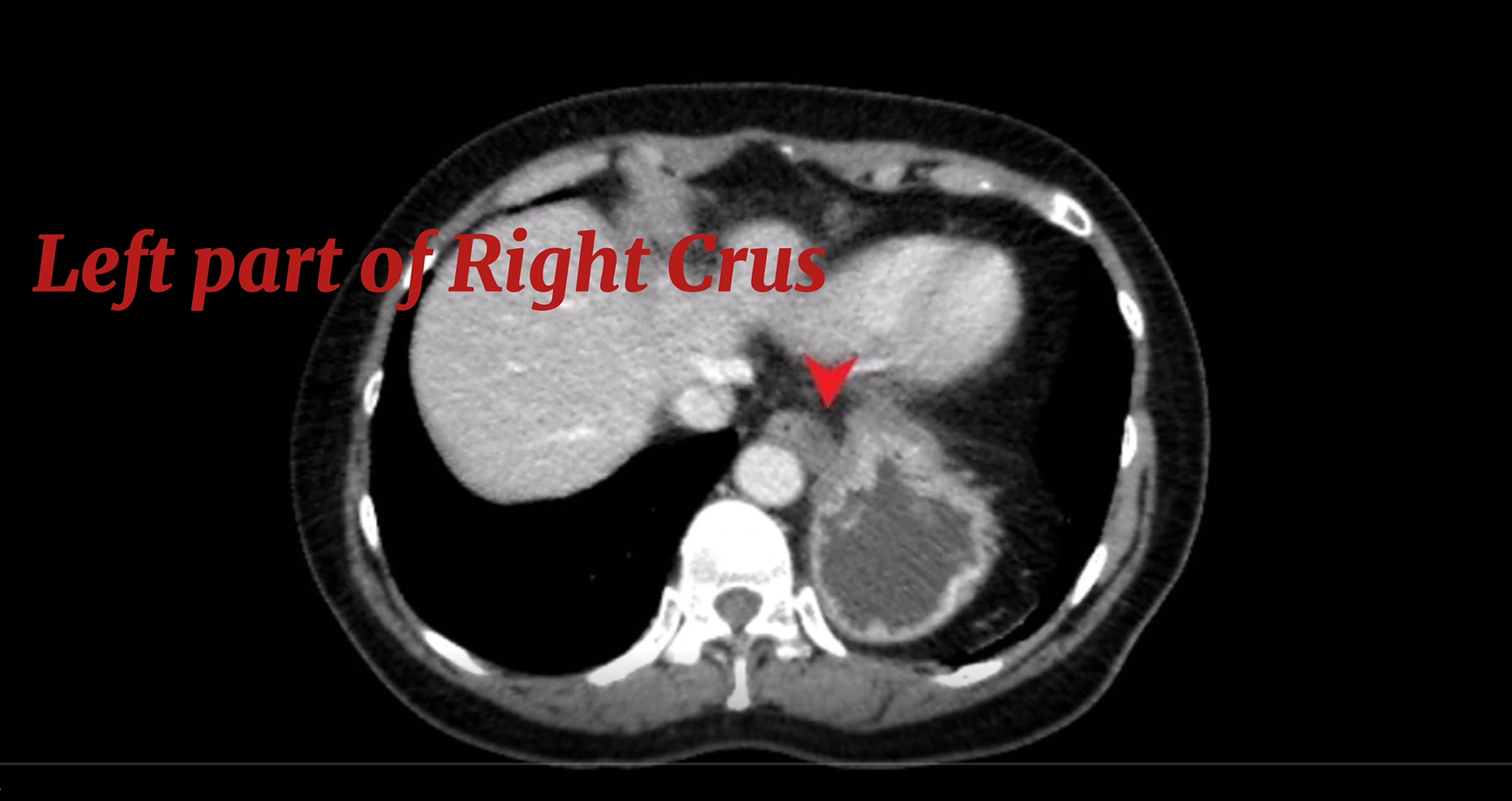 <p>Right Crus of Diaphragm, Sagittal View