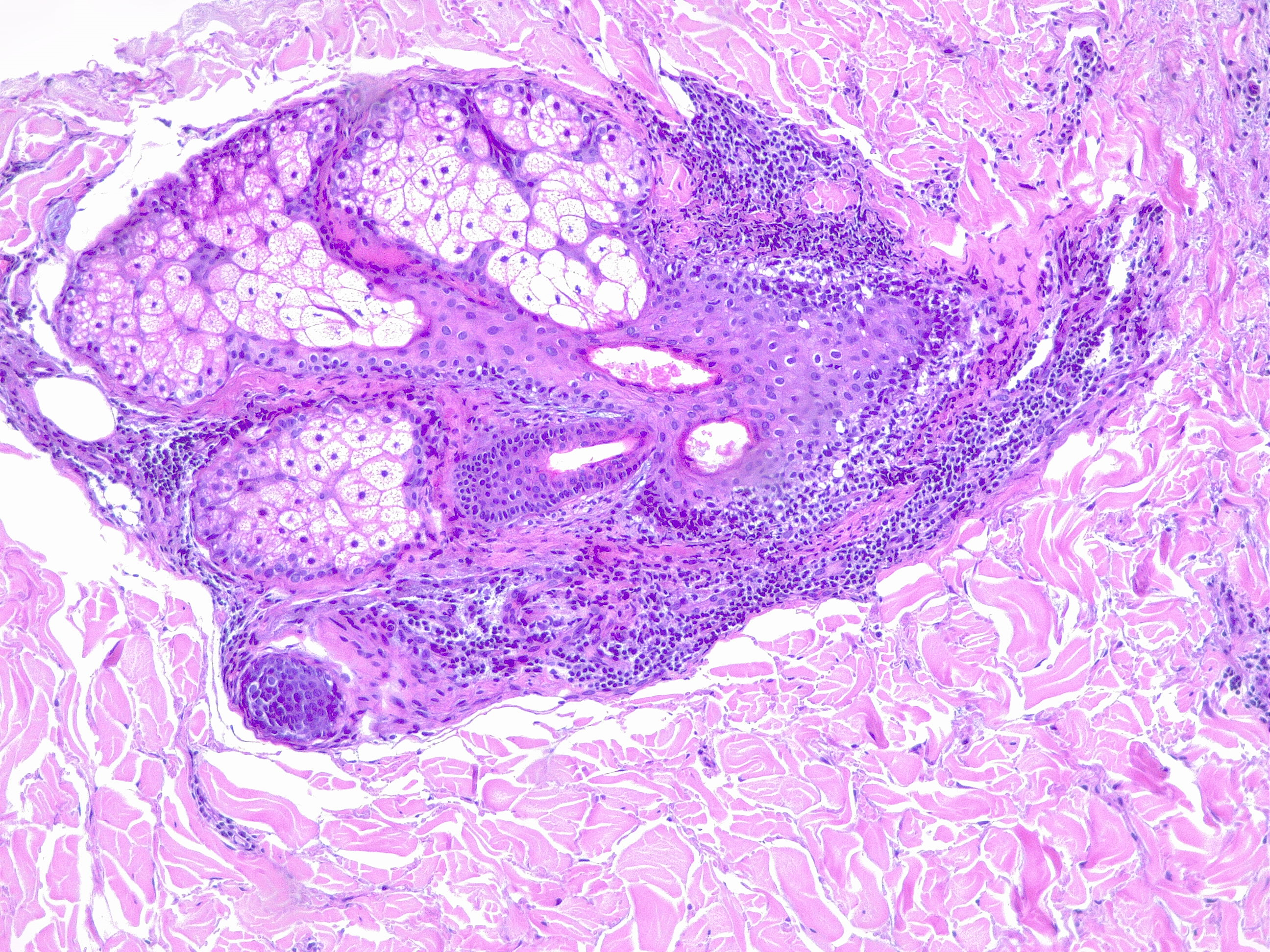 Dermatitis, chronic inflammatory infiltrate of the pilo-sebaceous unit. The surrounding dermis is unaffected. H/E 10x