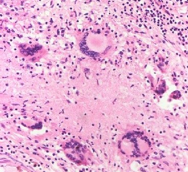 <p>Tuberculous Meningitis Histopathology