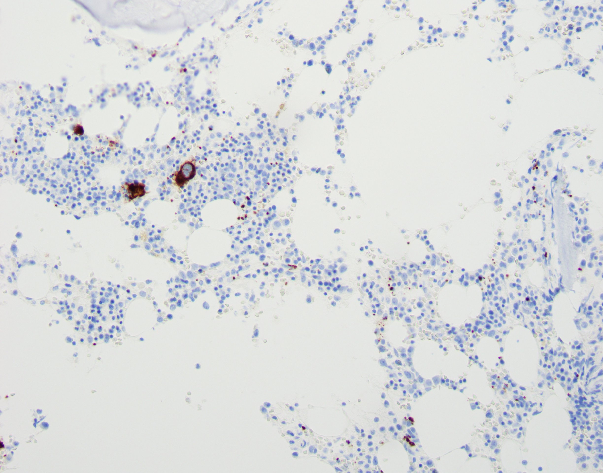 <p>Bone Marrow Core Biopsy