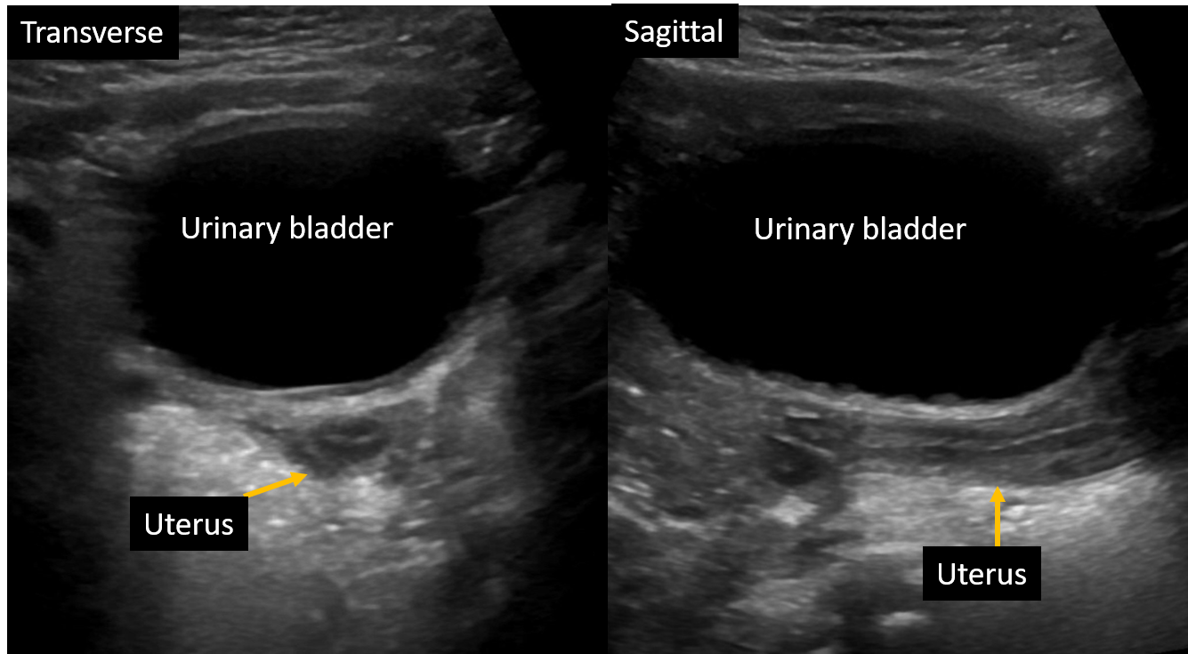 Transabdominal ultrasound : Normal tubular shaped uterus in 2 years old female. Transverse and sagittal images using fluid filled bladder as an acoustic window.