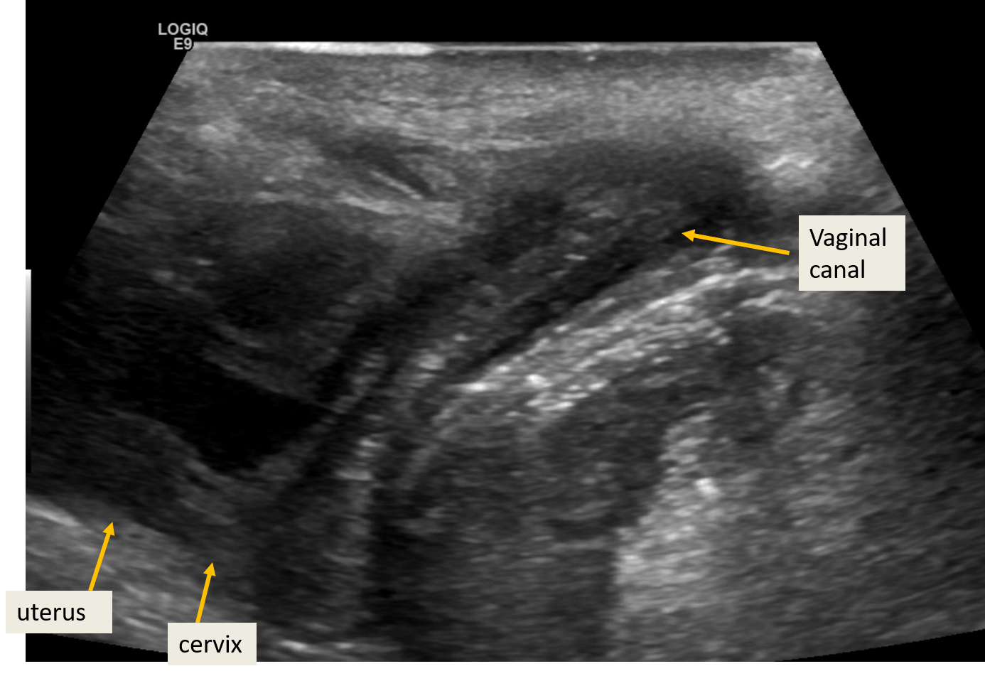 Translabial ultrasound of 2 year female- Normal appearance of vaginal canal, uterus and cervix.