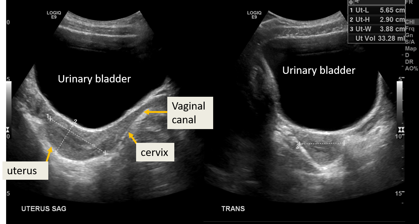 Normal transabdominal ultrasound of uterus in 17 year old female: Post pubertal pear shape of the uterus with more growth of the uterine fundus as compared to the cervix
