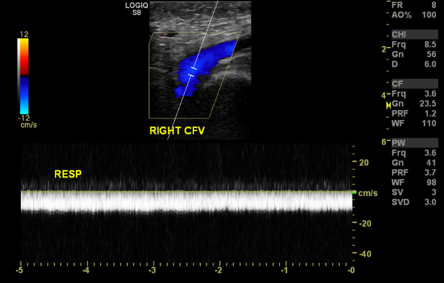 Loss of phasicity in the common femoral vein.