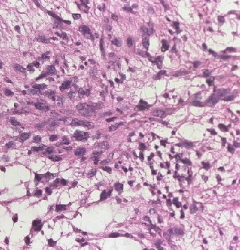 <p>Soft Tissue Fibrosarcoma</p>