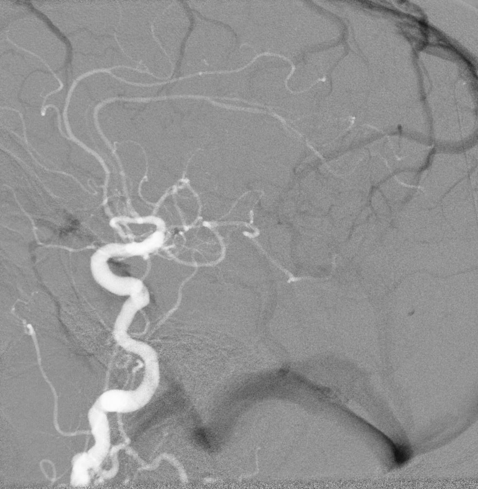 <p>Roadmapping,&nbsp;Cerebral Angiography</p>