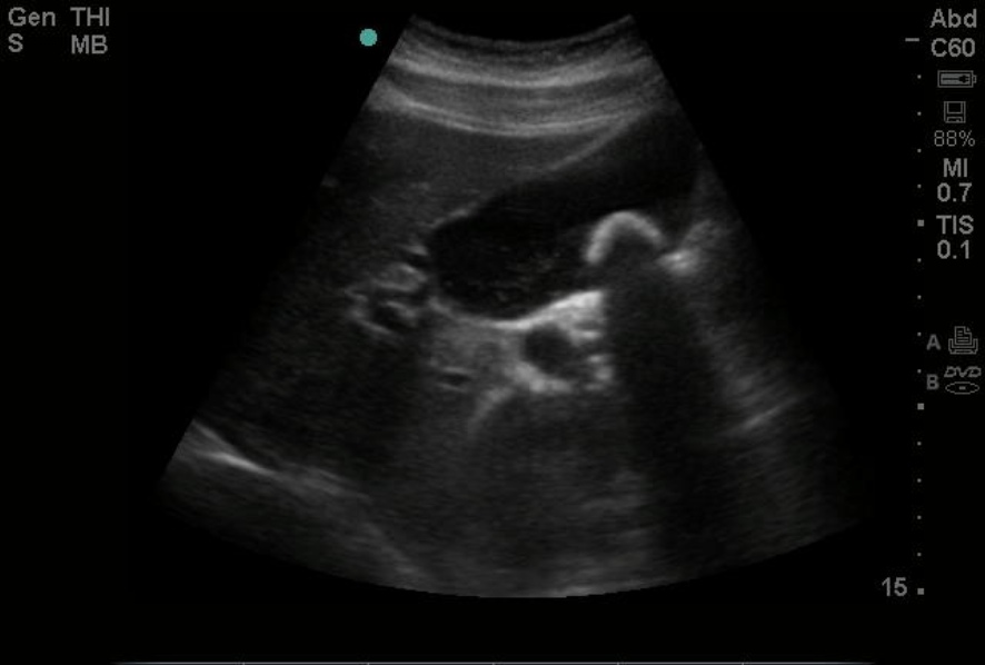 <p>Gallstone on Point-of-Care Ultrasound.</p>