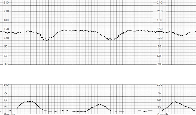 <p>Late Decelerations</p>