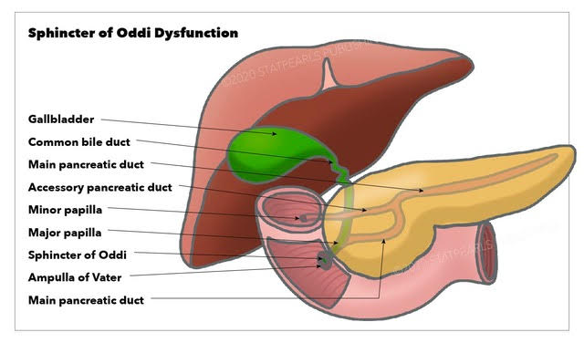 <p>Sphincter of Oddi Dysfunction.</p>