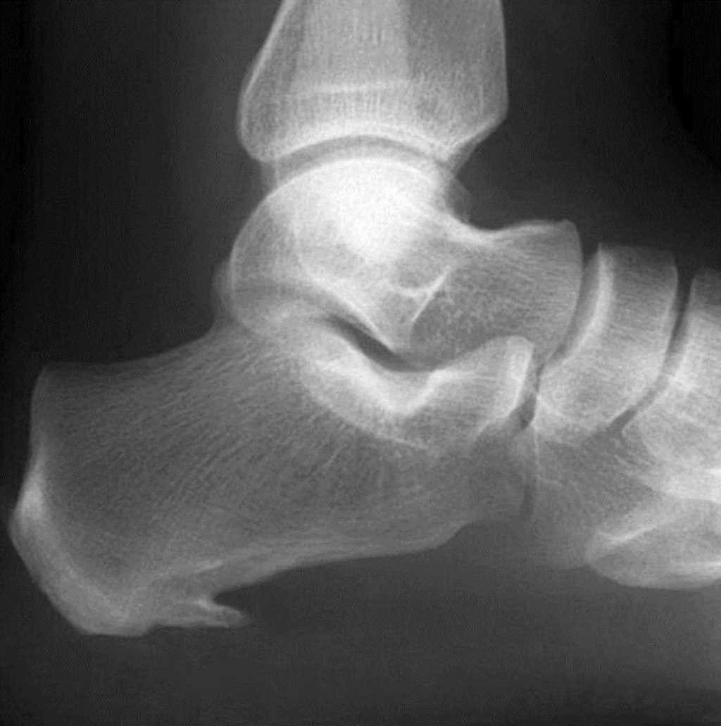 Lateral radiograph of the heel showing a large spur. This finding is present in approximately 50% of patients presenting with plantar fasciitis.