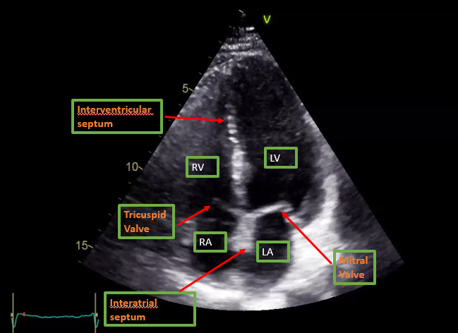 Apical Four chamber view on Transthoracic echocardiography