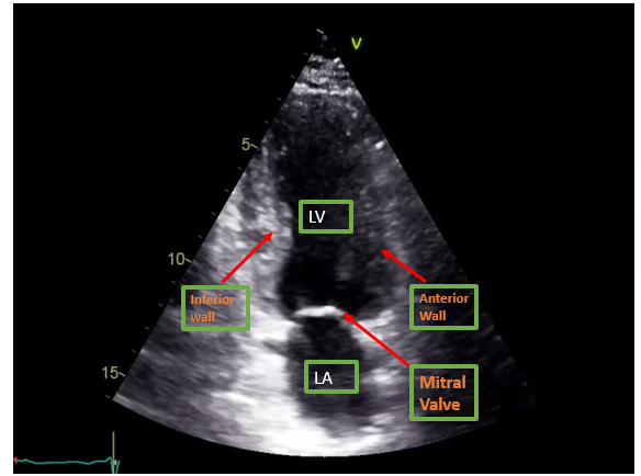 Apical Two chamber view on Transthoracic Echocardiography