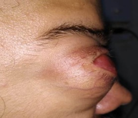 <p>Patient With Bilateral Microphthalmia With Cyst