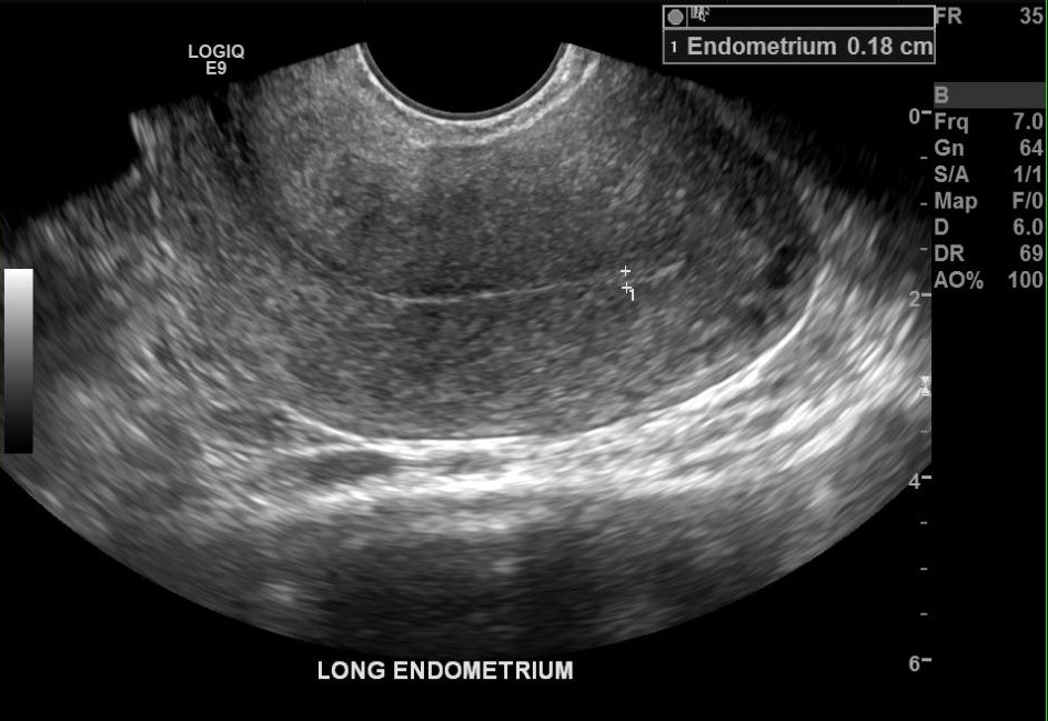 <p>Transvaginal Ultrasound