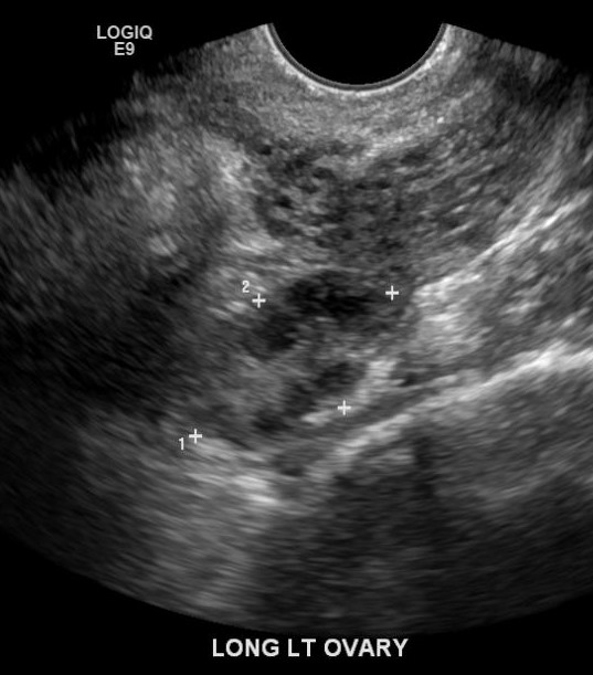 <p>Sagittal Image of the Left Ovary. Physiologic follicles are noted.</p>