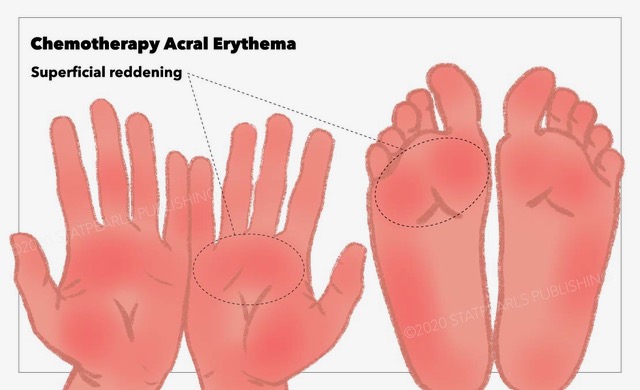 <p>Chemotherapy Acral Erythema