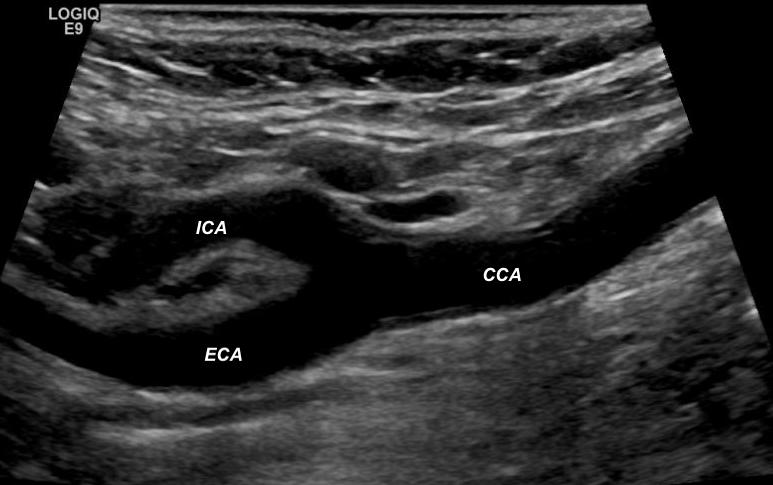 <p>Carotid Bifurcation on Ultrasonography